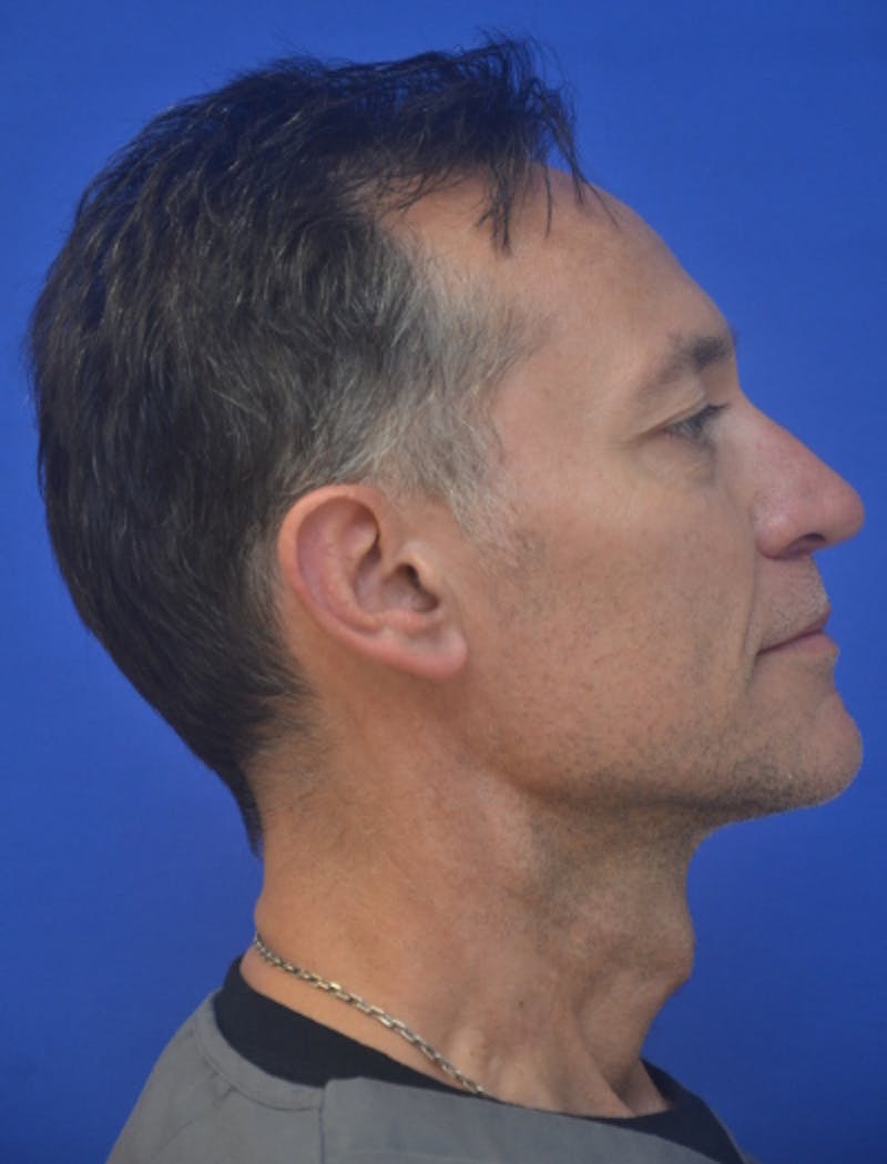Ear Pinning Surgery Before & After Gallery - Patient 408170 - Image 3