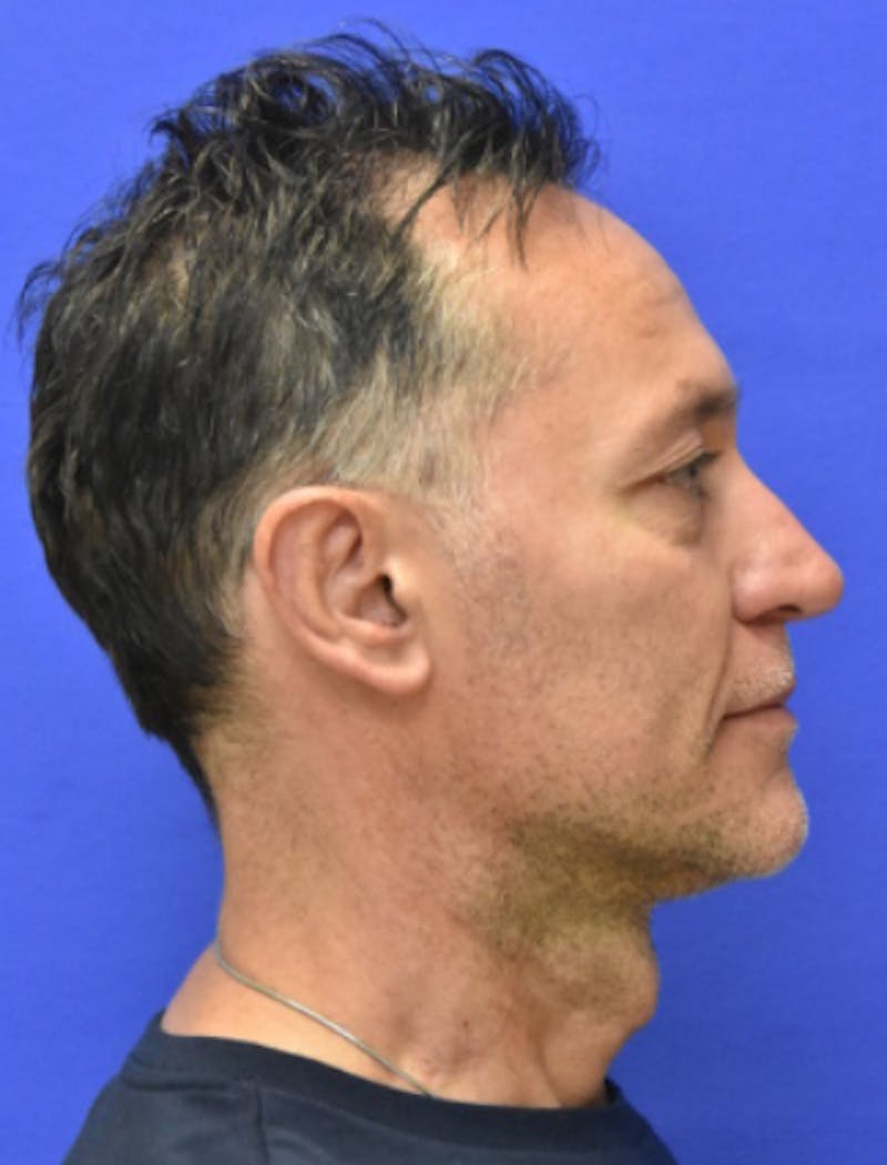 Ear Pinning Surgery Before & After Gallery - Patient 408170 - Image 4