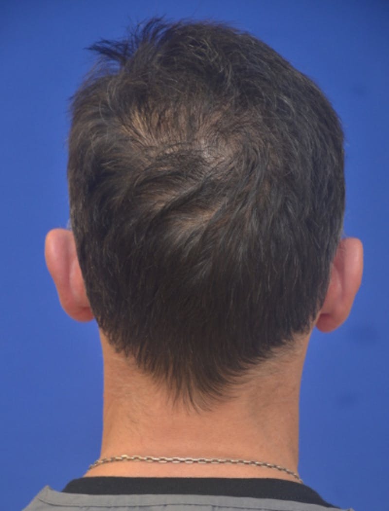 Ear Pinning Surgery Before & After Gallery - Patient 408170 - Image 5