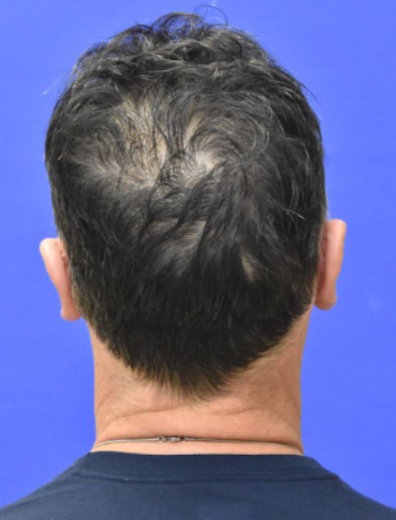 Ear Pinning Surgery Before & After Gallery - Patient 408170 - Image 6