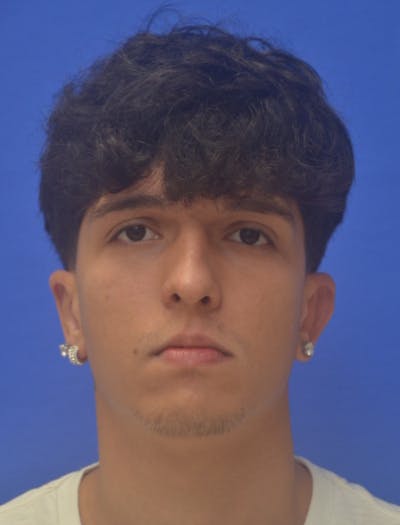 Ear Pinning Surgery Before & After Gallery - Patient 298169 - Image 2