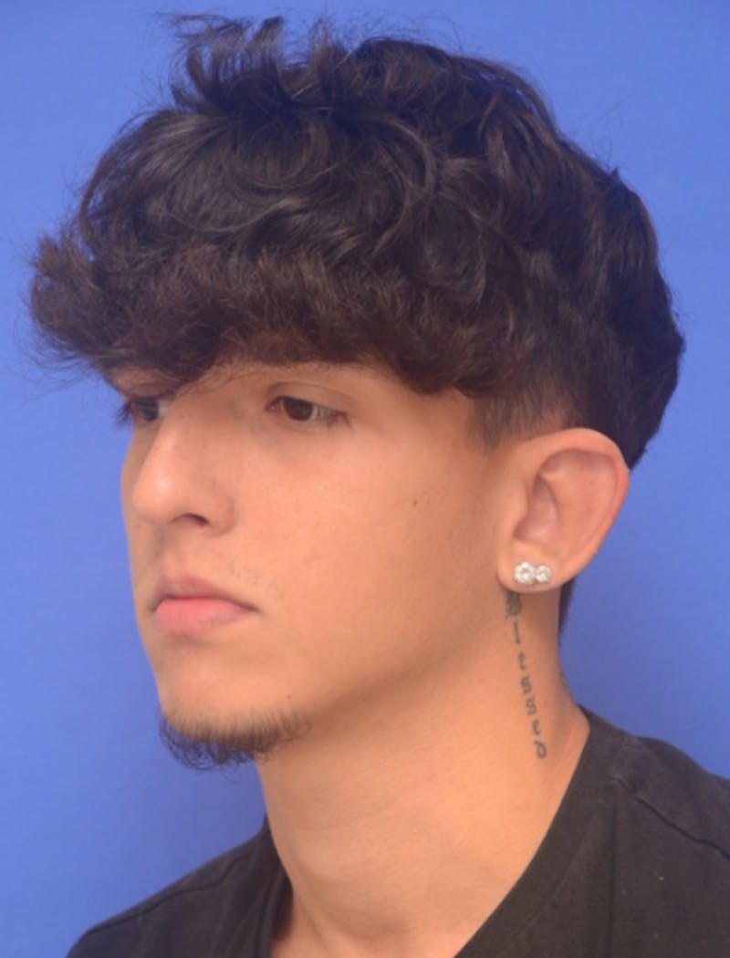 Ear Pinning Surgery Before & After Gallery - Patient 298169 - Image 3