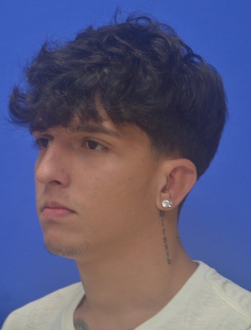 Ear Pinning Surgery Before & After Gallery - Patient 298169 - Image 4