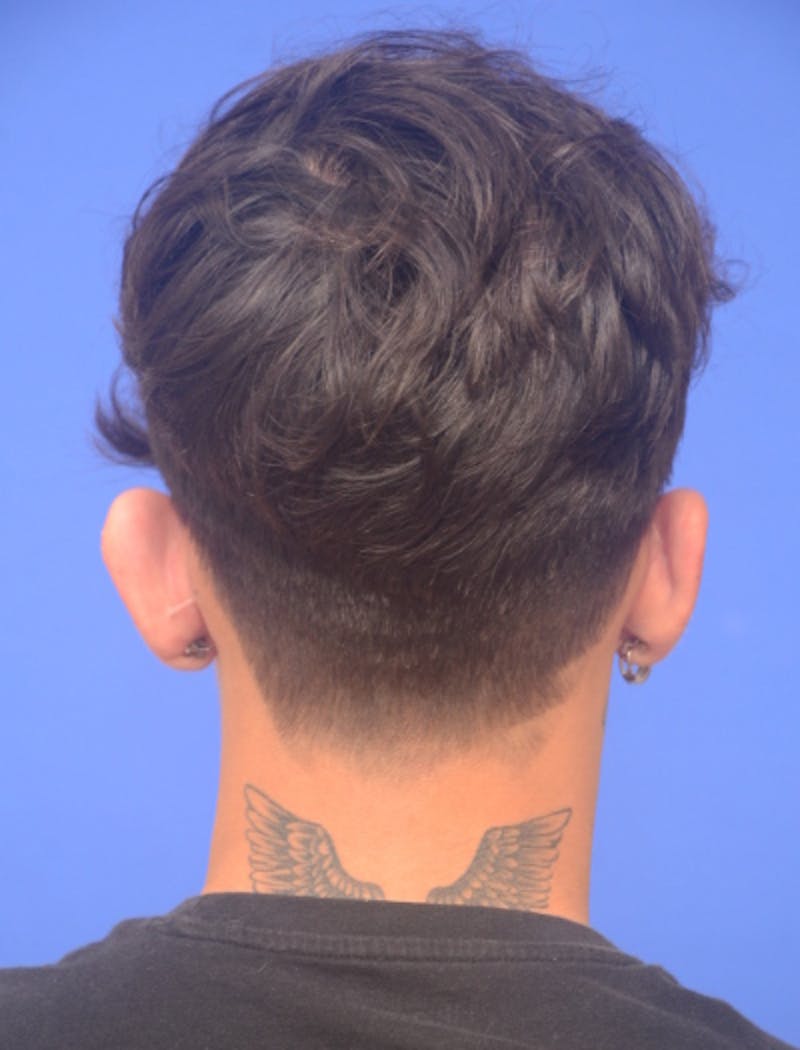 Ear Pinning Surgery Before & After Gallery - Patient 298169 - Image 5