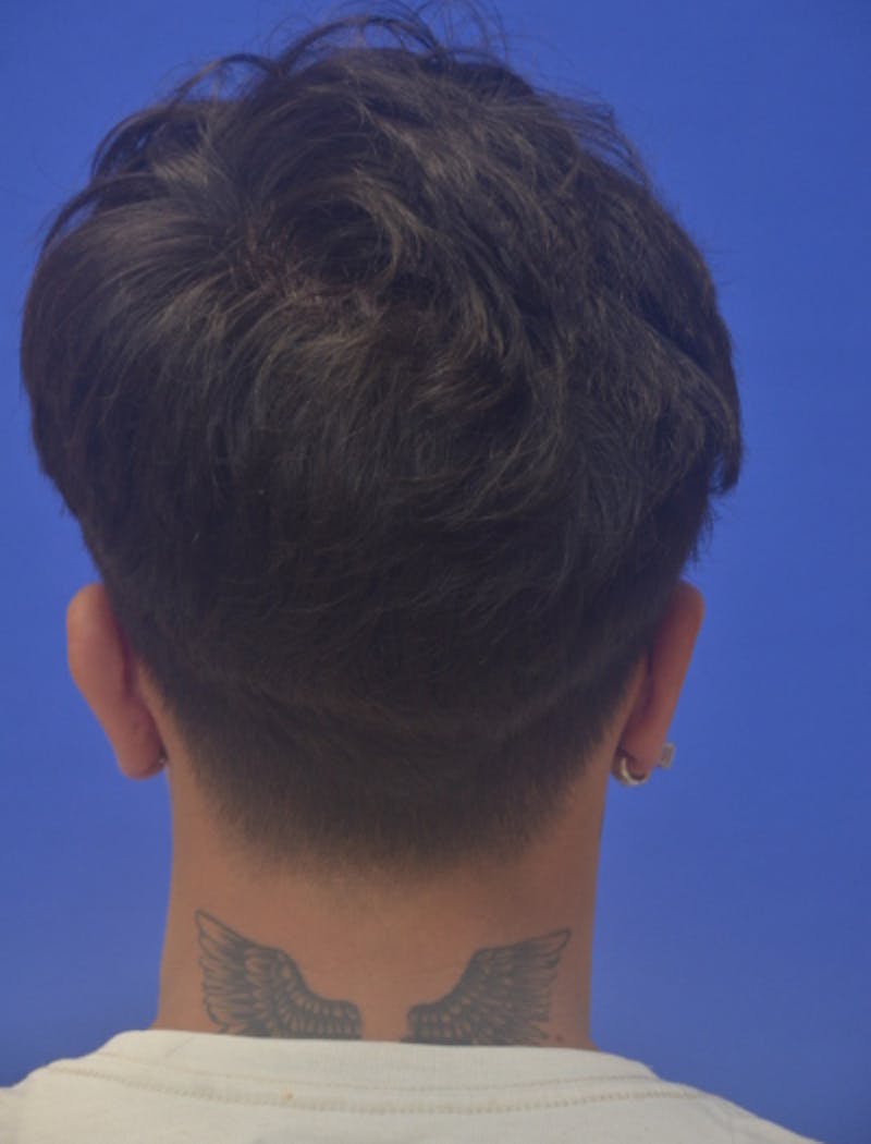 Ear Pinning Surgery Before & After Gallery - Patient 298169 - Image 6