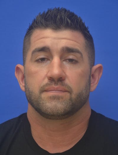 Ear Pinning Surgery Before & After Gallery - Patient 317116 - Image 1