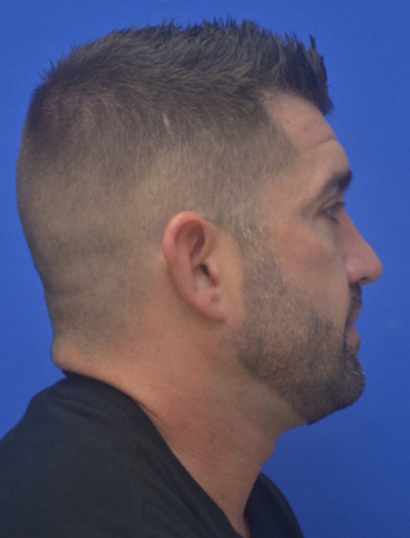 Ear Pinning Surgery Before & After Gallery - Patient 317116 - Image 3