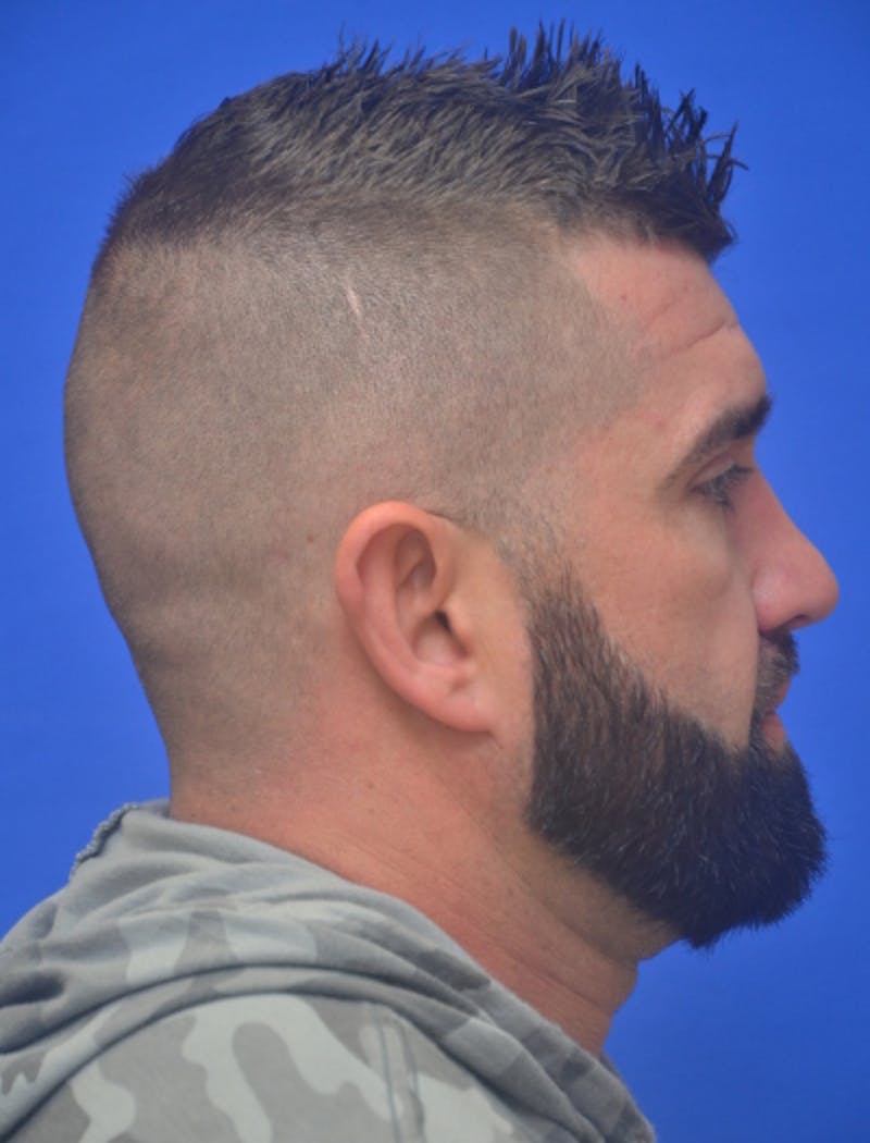 Ear Pinning Surgery Before & After Gallery - Patient 317116 - Image 4