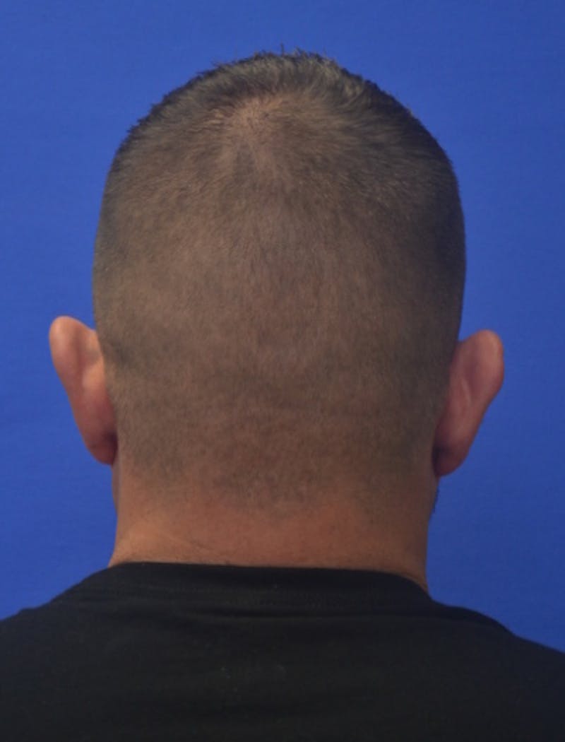 Ear Pinning Surgery Before & After Gallery - Patient 317116 - Image 5