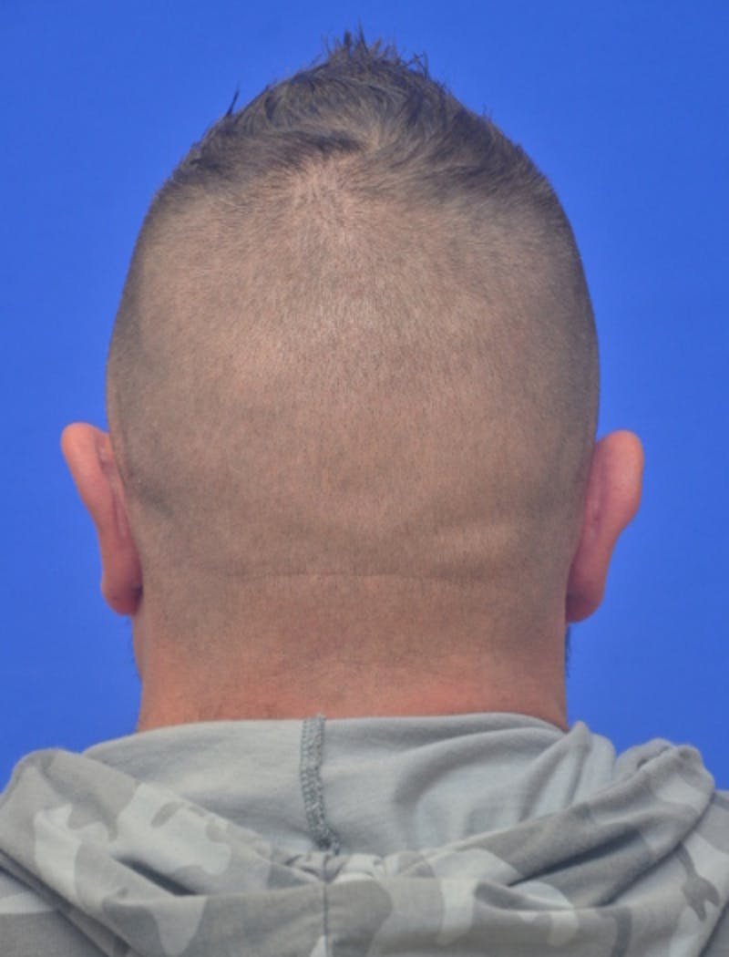 Ear Pinning Surgery Before & After Gallery - Patient 317116 - Image 6