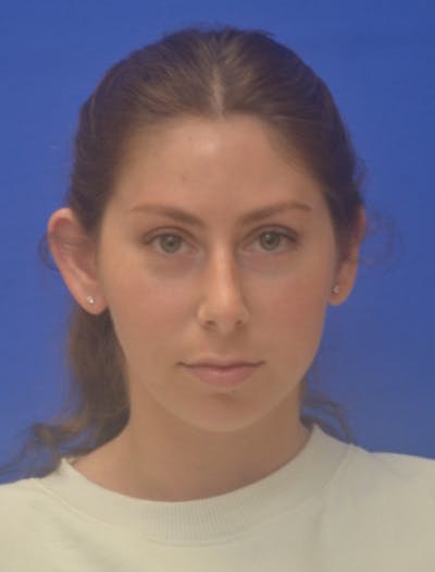 Ear Pinning Surgery Before & After Gallery - Patient 873503 - Image 1