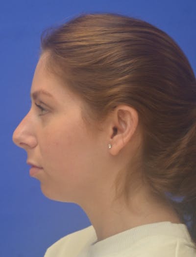 Ear Pinning Surgery Before & After Gallery - Patient 873503 - Image 2