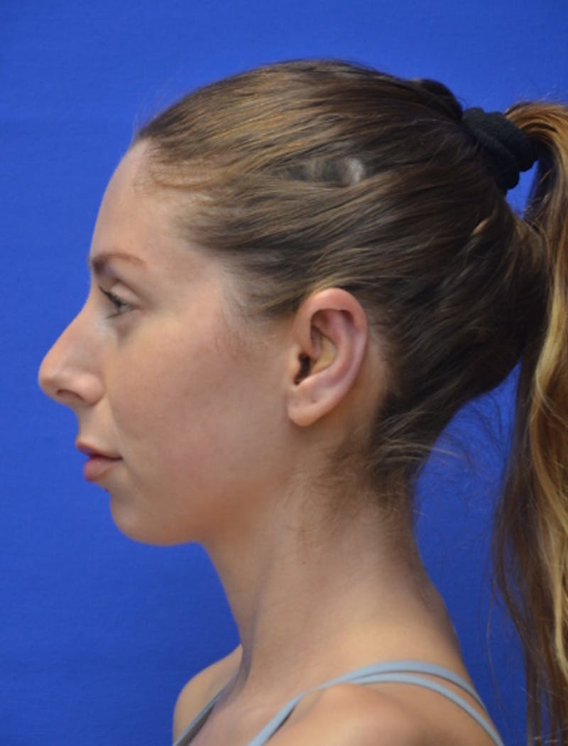 Ear Pinning Surgery Before & After Gallery - Patient 873503 - Image 3