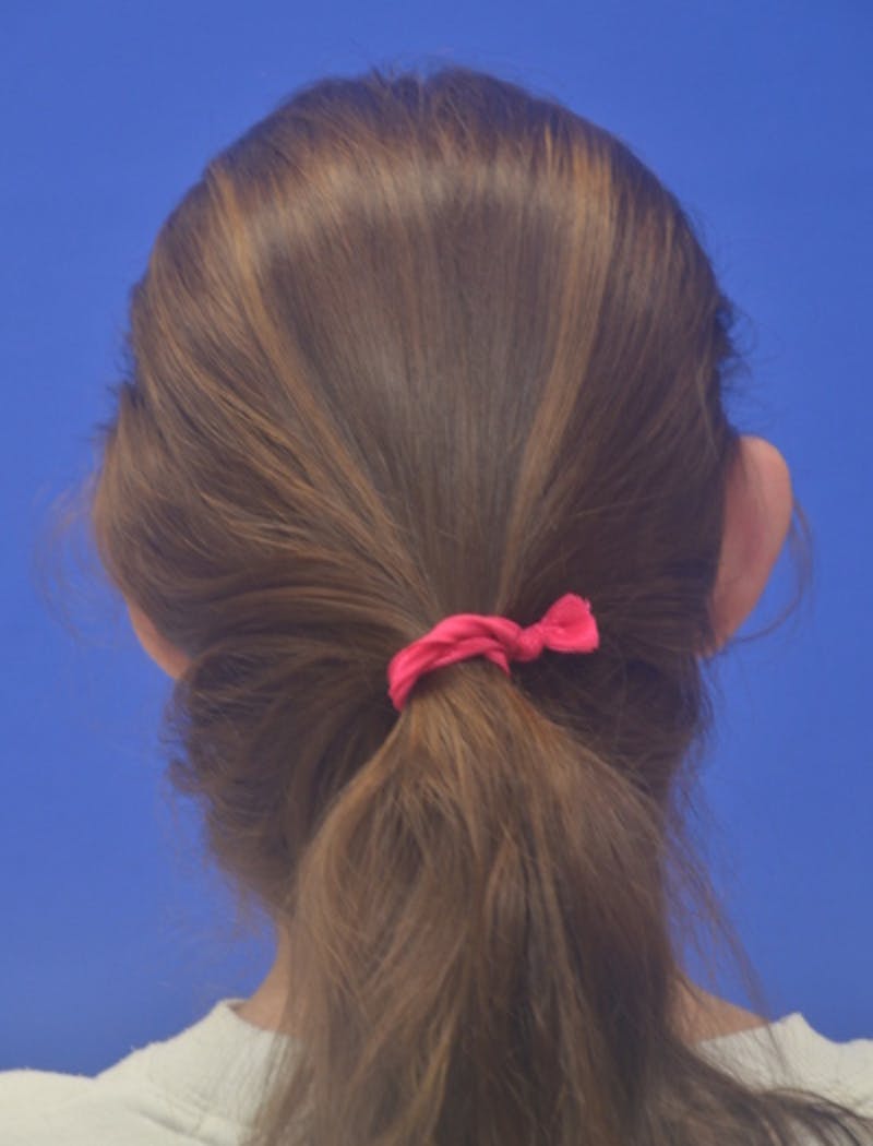 Ear Pinning Surgery Before & After Gallery - Patient 873503 - Image 4