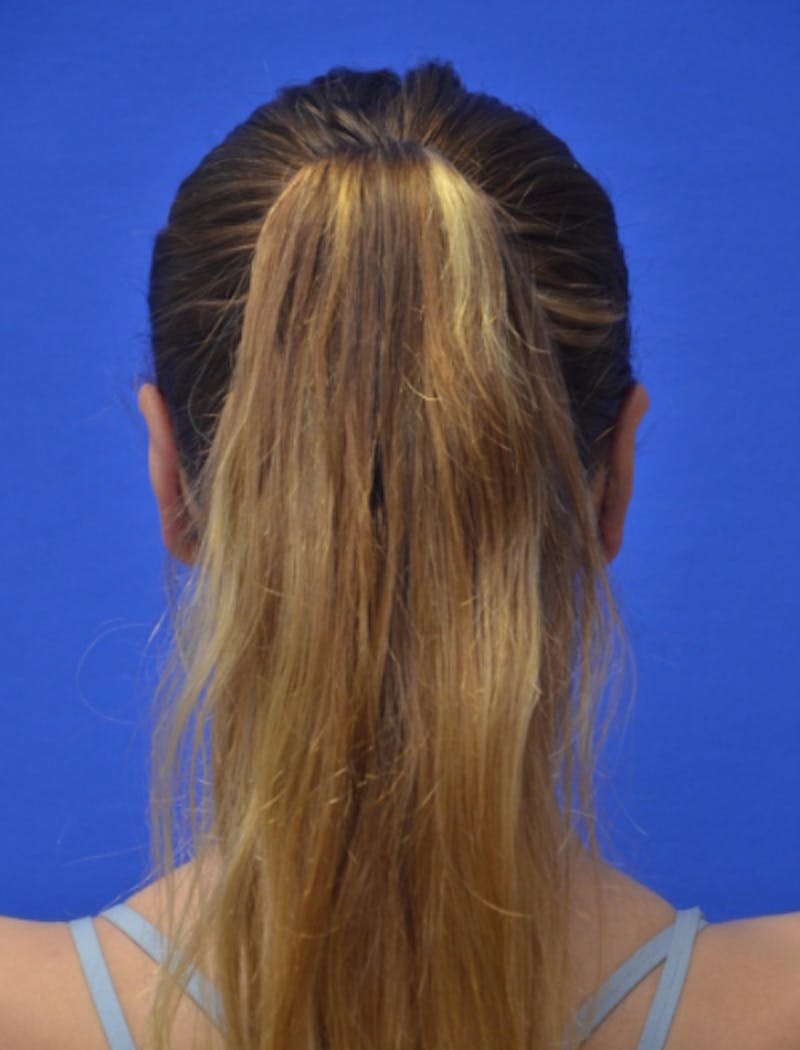 Ear Pinning Surgery Before & After Gallery - Patient 873503 - Image 5