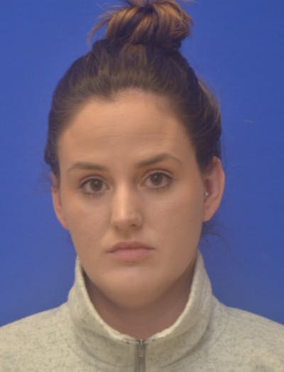 Ear Pinning Surgery Before & After Gallery - Patient 102169 - Image 1