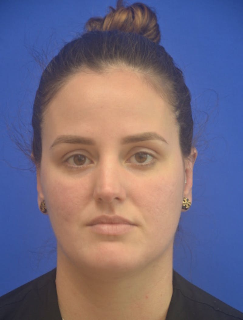 Ear Pinning Surgery Before & After Gallery - Patient 102169 - Image 2