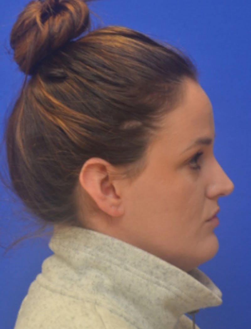 Ear Pinning Surgery Before & After Gallery - Patient 102169 - Image 3