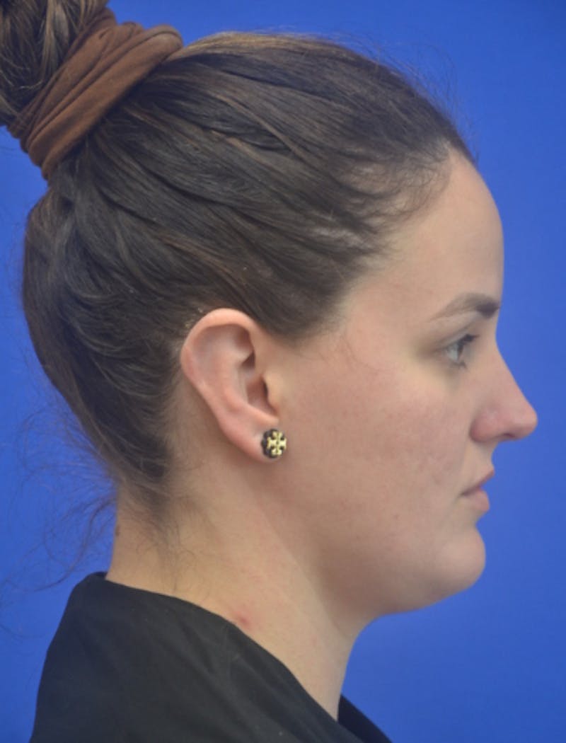 Ear Pinning Surgery Before & After Gallery - Patient 102169 - Image 4