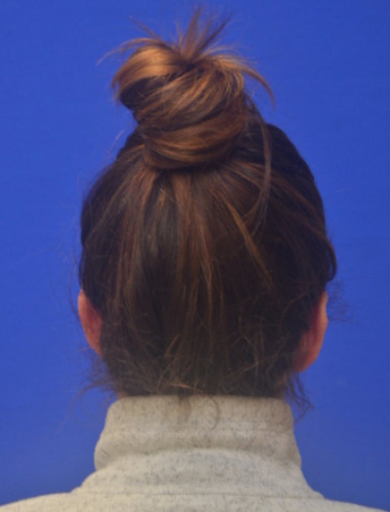 Ear Pinning Surgery Before & After Gallery - Patient 102169 - Image 5