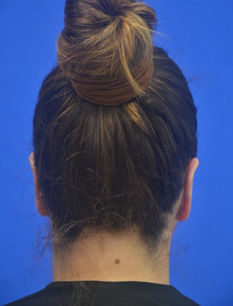 Ear Pinning Surgery Before & After Gallery - Patient 102169 - Image 6
