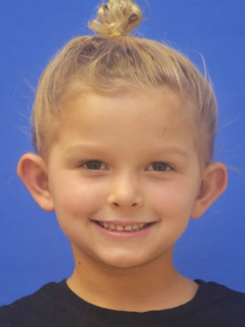 Ear Pinning Surgery Before & After Gallery - Patient 453500 - Image 1