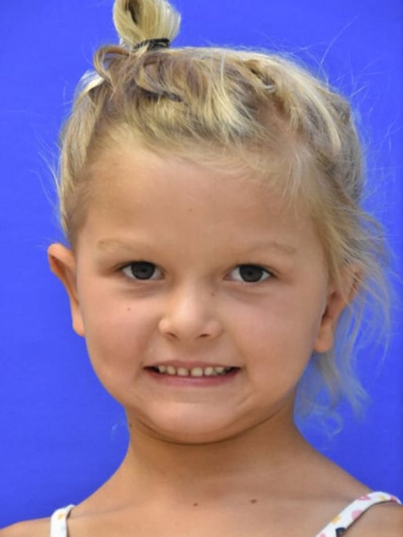 Ear Pinning Surgery Before & After Gallery - Patient 453500 - Image 2