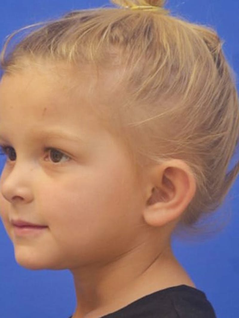 Ear Pinning Surgery Before & After Gallery - Patient 453500 - Image 3