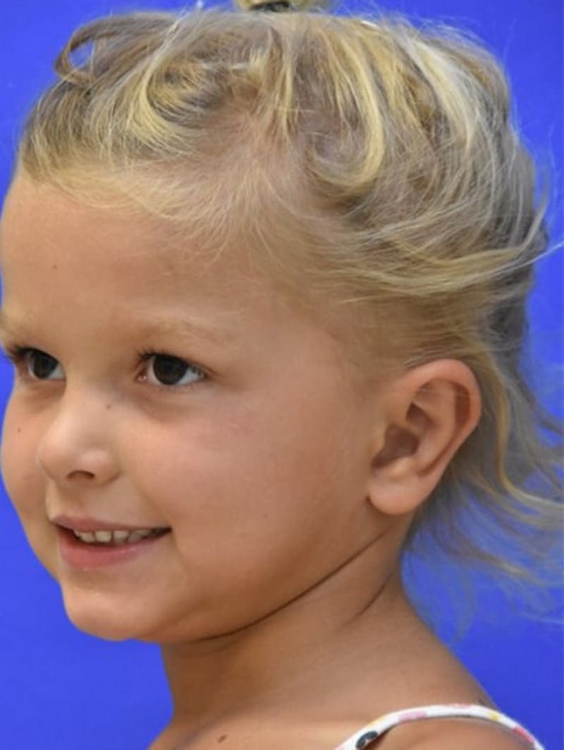 Ear Pinning Surgery Before & After Gallery - Patient 453500 - Image 4