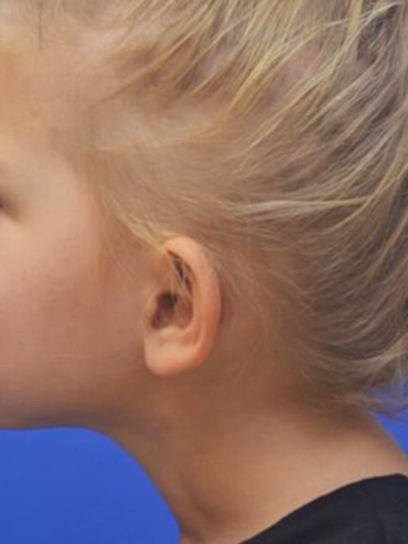 Ear Pinning Surgery Before & After Gallery - Patient 453500 - Image 5
