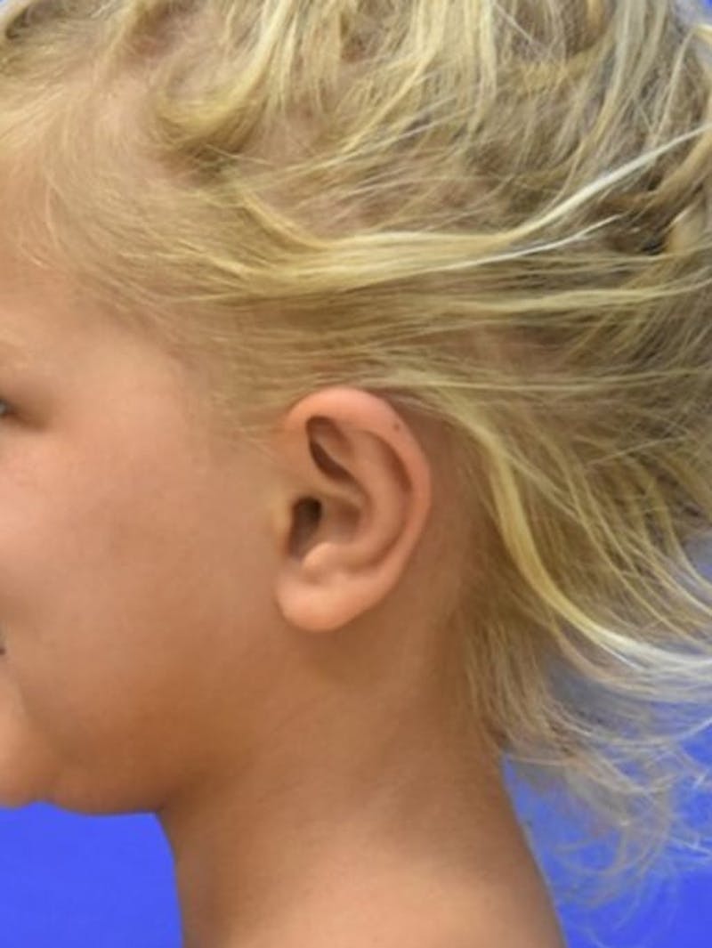 Ear Pinning Surgery Before & After Gallery - Patient 453500 - Image 6