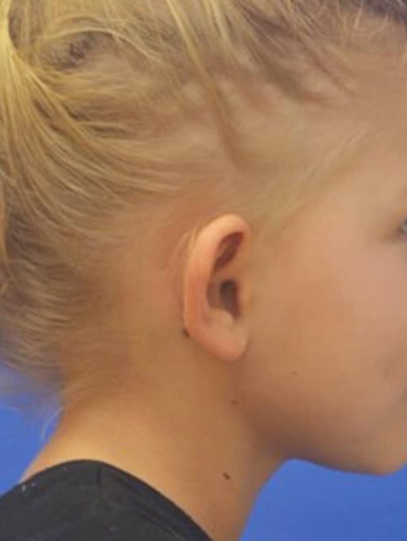 Ear Pinning Surgery Before & After Gallery - Patient 453500 - Image 7