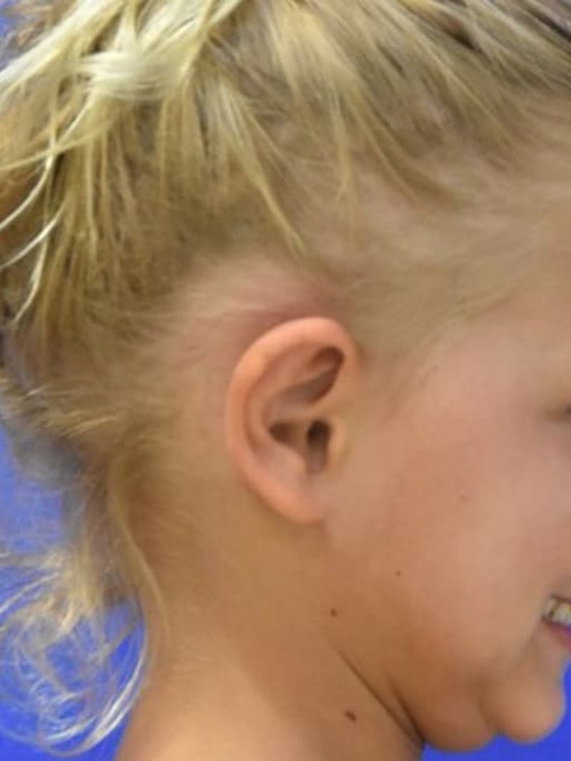 Ear Pinning Surgery Before & After Gallery - Patient 453500 - Image 8