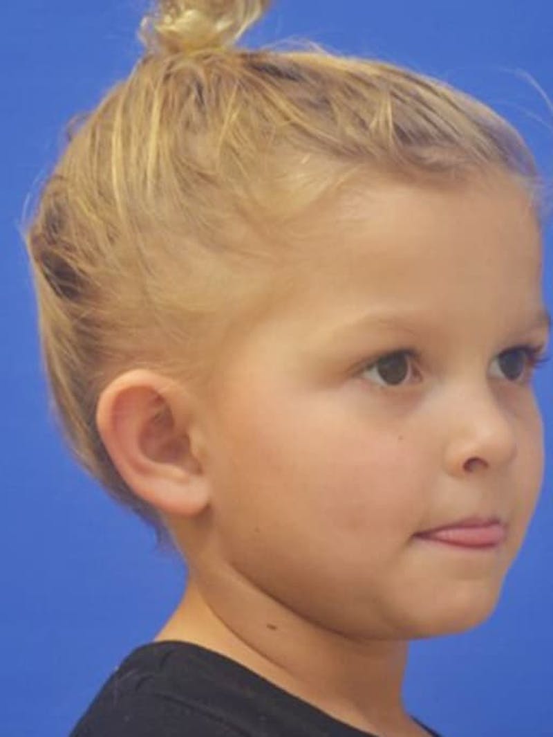 Ear Pinning Surgery Before & After Gallery - Patient 453500 - Image 9