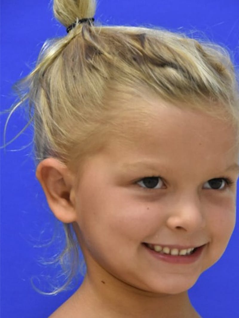 Ear Pinning Surgery Before & After Gallery - Patient 453500 - Image 10