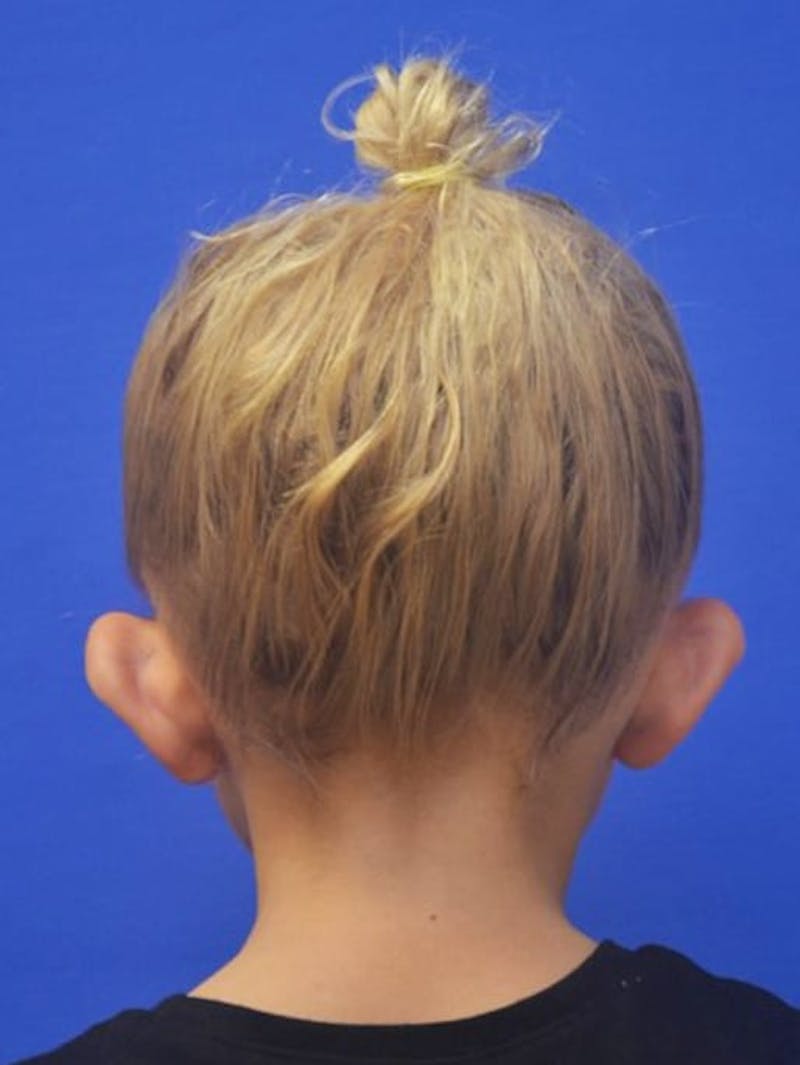 Ear Pinning Surgery Before & After Gallery - Patient 453500 - Image 11
