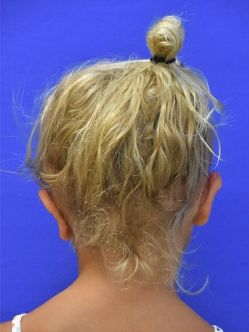 Ear Pinning Surgery Before & After Gallery - Patient 453500 - Image 12