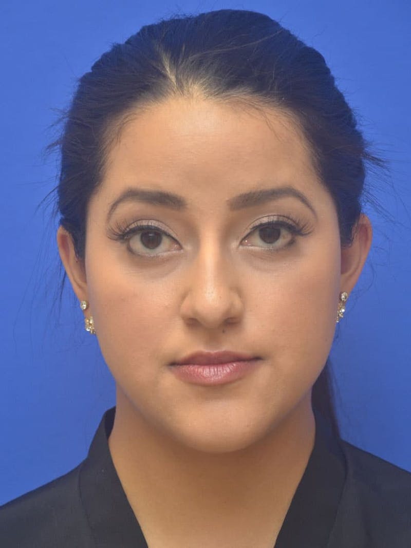 Ear Pinning Surgery Before & After Gallery - Patient 308826 - Image 1
