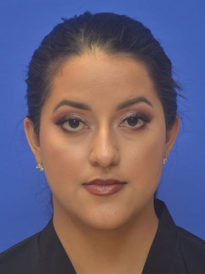 Ear Pinning Surgery Before & After Gallery - Patient 308826 - Image 2