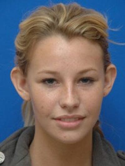 Ear Pinning Surgery Before & After Gallery - Patient 107217 - Image 1