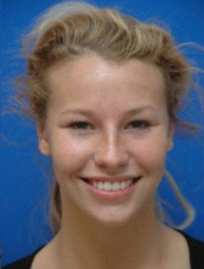 Ear Pinning Surgery Before & After Gallery - Patient 107217 - Image 2