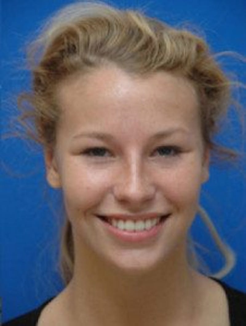 Ear Pinning Surgery Before & After Gallery - Patient 107217 - Image 2