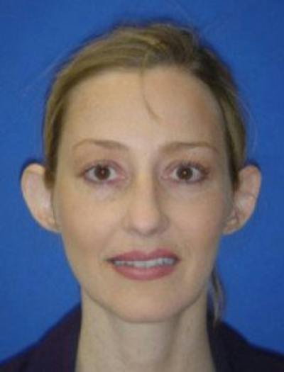 Ear Pinning Surgery Before & After Gallery - Patient 175852 - Image 1
