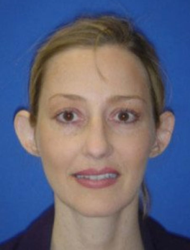 Ear Pinning Surgery Before & After Gallery - Patient 175852 - Image 1