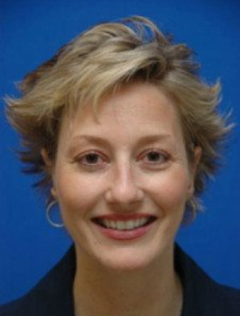 Ear Pinning Surgery Before & After Gallery - Patient 175852 - Image 2