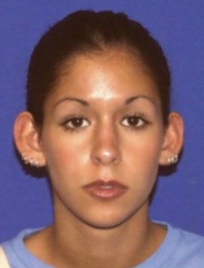 Ear Pinning Surgery Before & After Gallery - Patient 132096 - Image 1