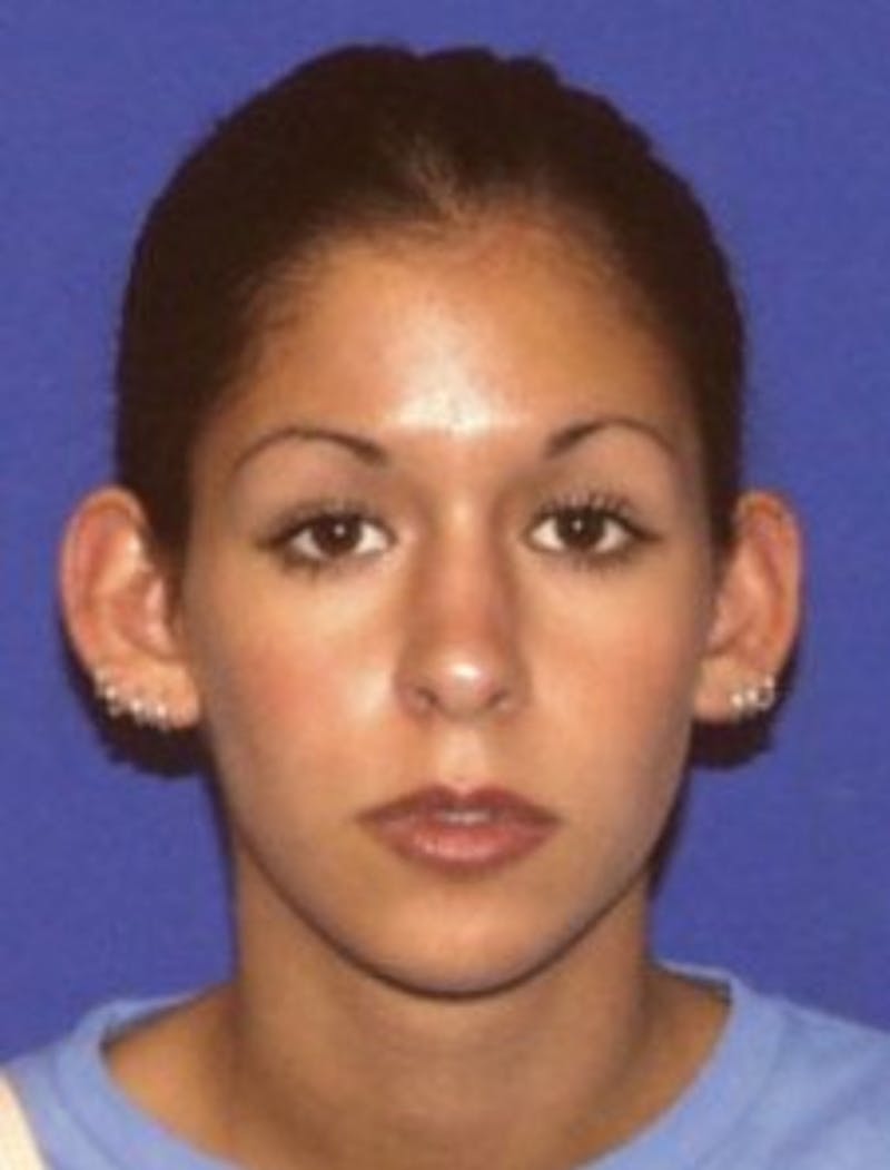 Ear Pinning Surgery Before & After Gallery - Patient 132096 - Image 1