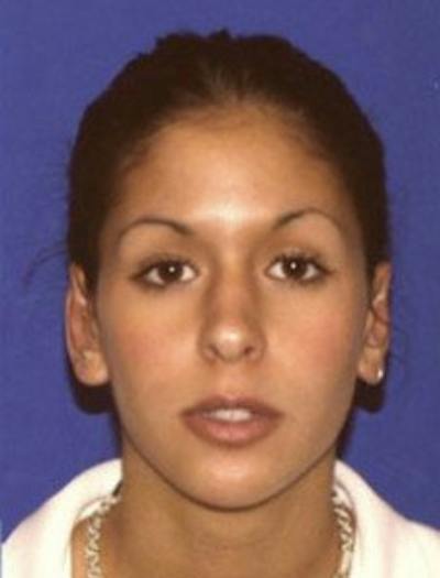 Ear Pinning Surgery Before & After Gallery - Patient 132096 - Image 2