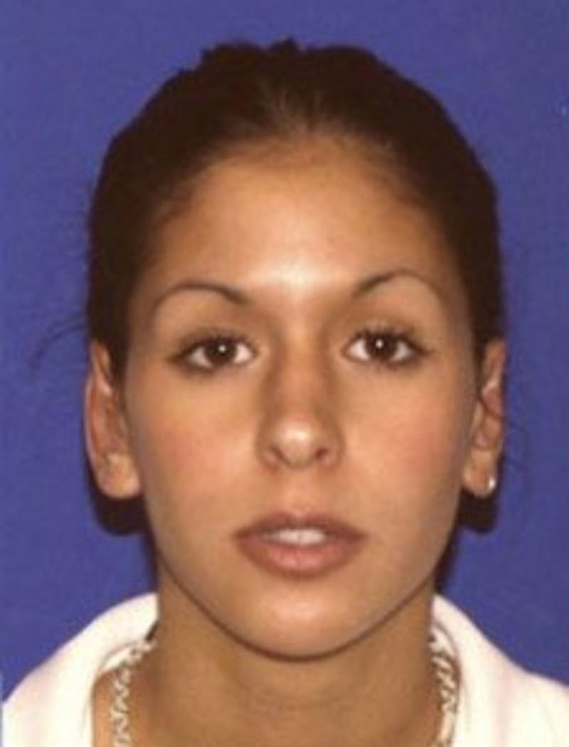 Ear Pinning Surgery Before & After Gallery - Patient 132096 - Image 2