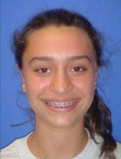 Ear Pinning Surgery Before & After Gallery - Patient 313356 - Image 2